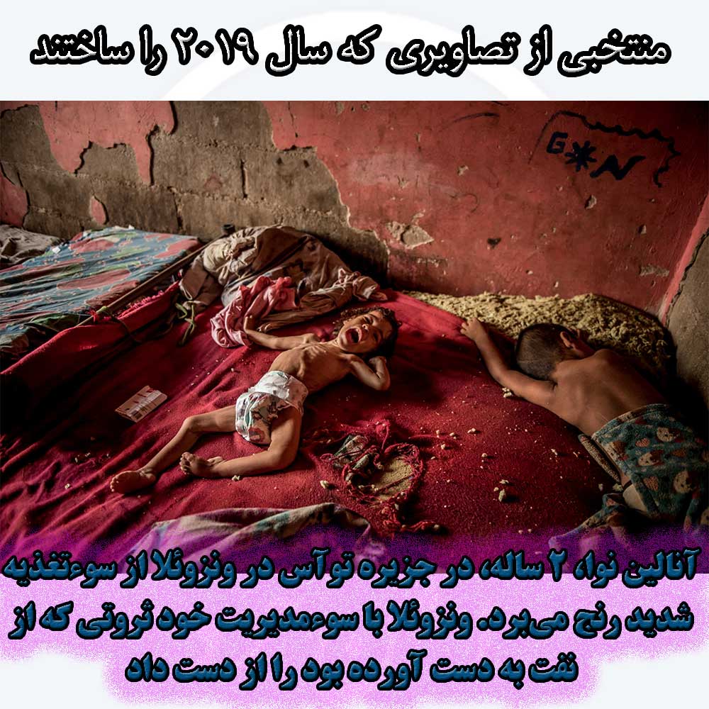 آنالین نوا، ۲ ساله، در جزیره توآس در ونزوئلا از سوءتغذیه شدید رنج می‌برد.